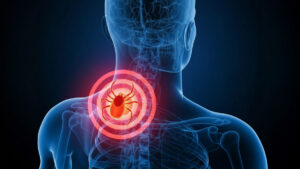 Lymes Disease, a Health Hint offered by Archangel Michael Orthodox Church in Cleveland